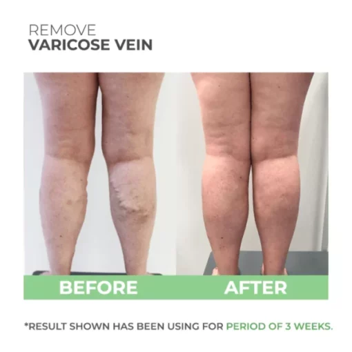 Wormwood Varicose Veins Care Soap - Image 4