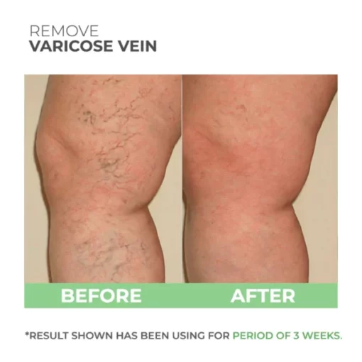 Wormwood Varicose Veins Care Soap - Image 3