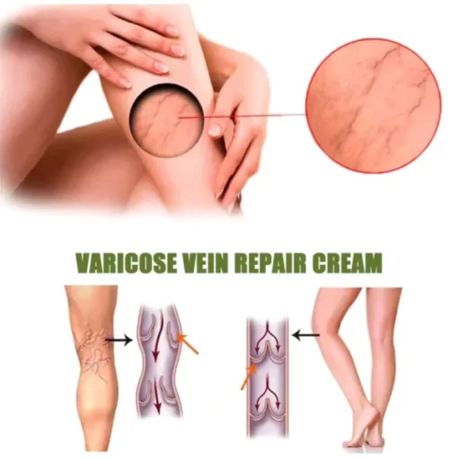 Oveallgo™ Varicose Veins Spray - Image 3