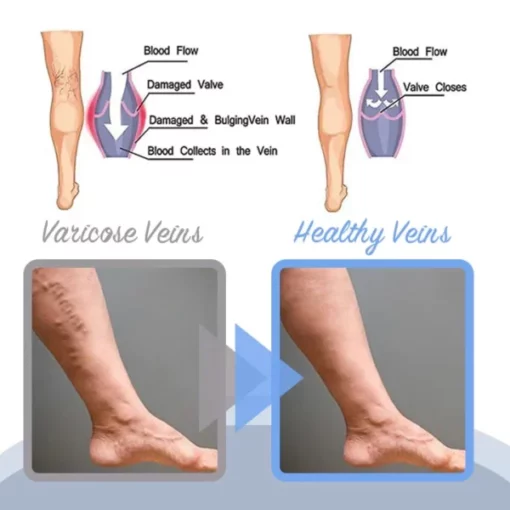 Oveallgo™ Varicose Veins Spray - Image 4