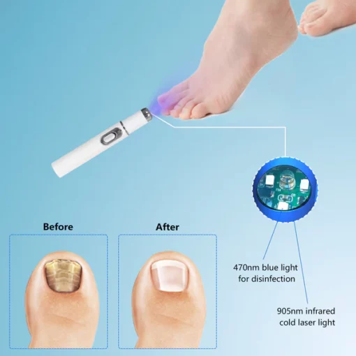 ARRIVALS Antifungal Laser Device Without Any Side Effects - Image 9