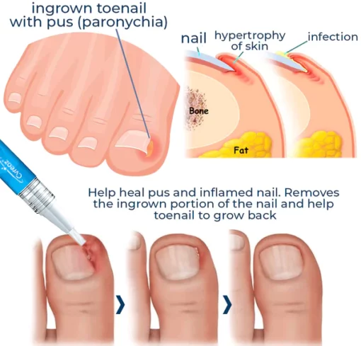 LEFUN Removal Paronychia Gel - Image 3