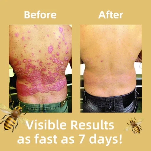 Oveallgo™ PRO Bienen Gift Psoriasis Behandlungscreme