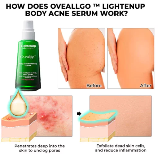 Oveallgo™ LightenUp Body Acne Serum - Image 3