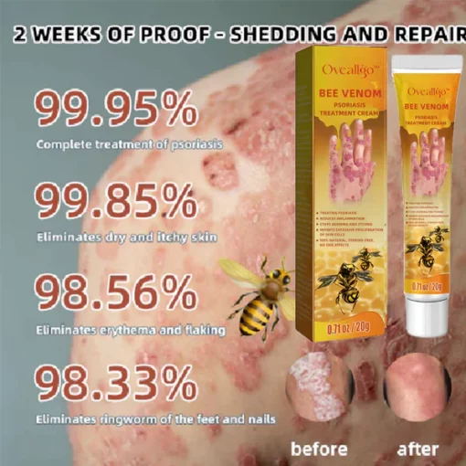 Oveallgo™ PRO Bienen Gift Psoriasis Behandlungscreme