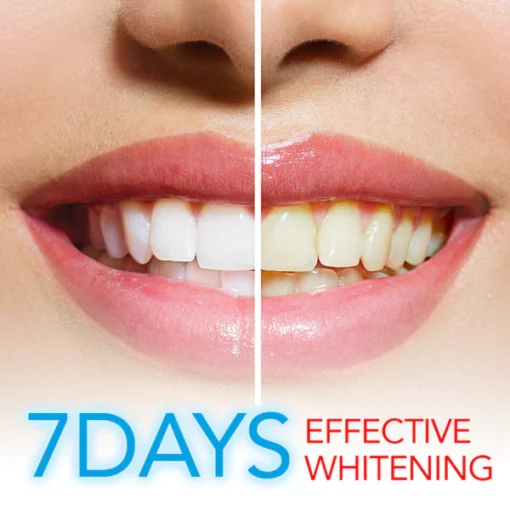 PureWhite Teeth™ Whitening Kit - Image 7