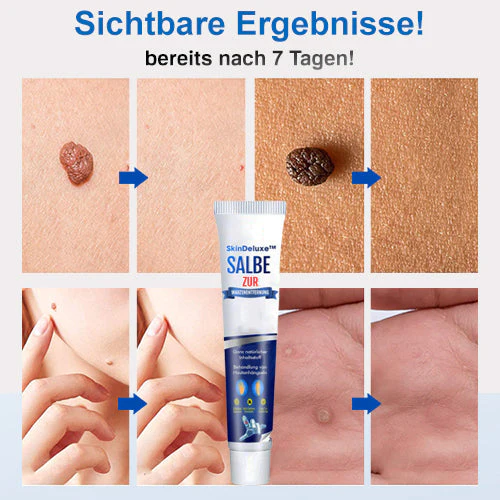 SkinDeluxe Salbe zur Warzenentfernung