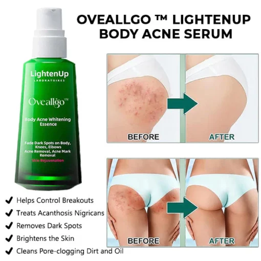 Oveallgo™ Körper Aufhellen Akne-Serum (zur Entfernung von Akne, Pickeln und Acanthosis nigricans)