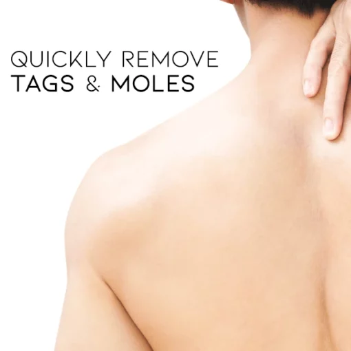 Oveallgo™ Nano-X WipeOff Tags & Moles Remover - Image 4