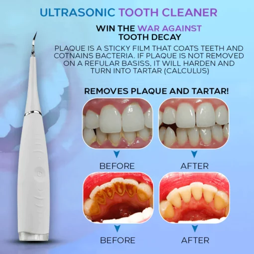 Seurico  Remove Tartar