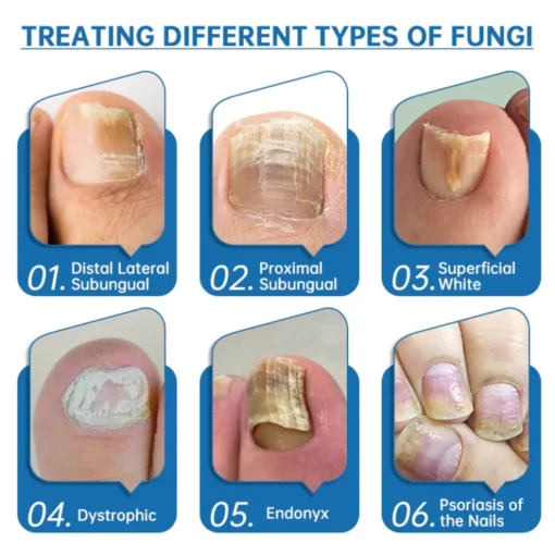 Furzero™ Highly Effective Onychomycosis Machine laser device - Image 4