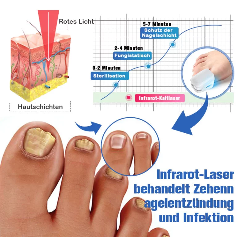 Furzero Nagelpilz-Laserbehandlungsger