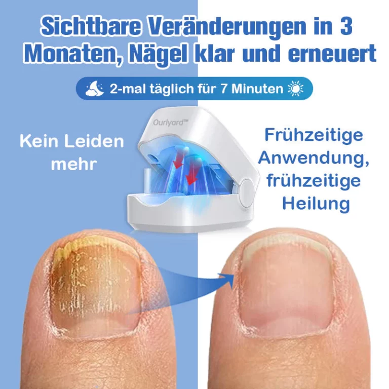 Furzero Nagelpilz-Laserbehandlungsger