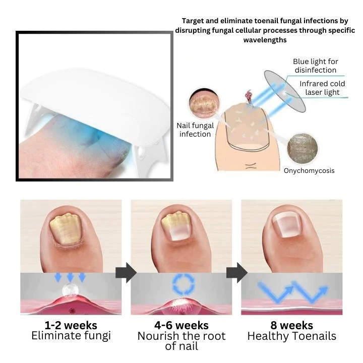 Oveallgo PROMAX Revolutionary Light Therapy Device For Toenail Diseases