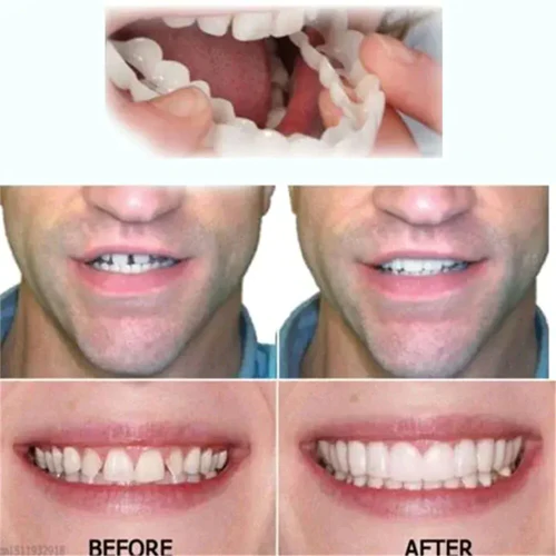 Oveallgo SMILE Adjustable Snap-On Dentures