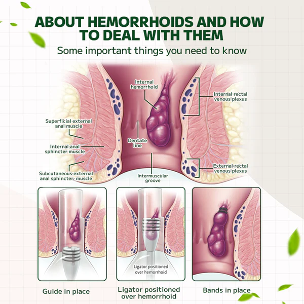 Lotmay Maximum Strength Hemorrhoids and Fissure Ointment