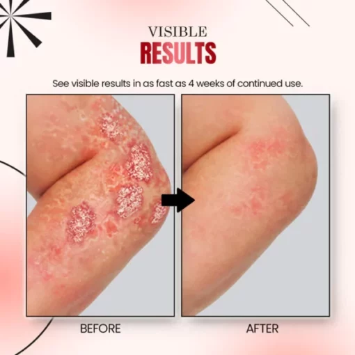 Ourlyard™ Psoriasis Relief Spray - Image 7