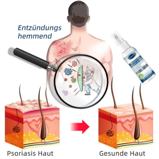 Ourlyard™ Psoriasis Relief Spray - Image 3