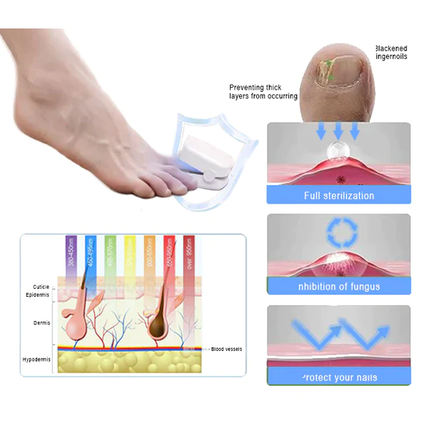 Oveallgo Expert Revolutionary High-Efficiency Light Therapy Device For Toenail Diseases