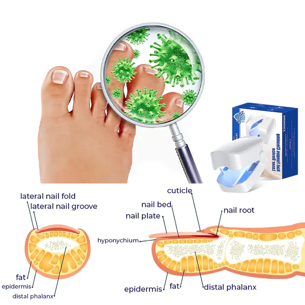 Oveallgo Expert Revolutionary High-Efficiency Light Therapy Device For Toenail Diseases