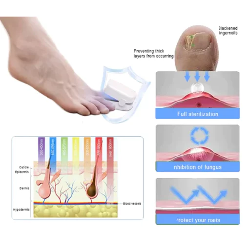 Oveallgo™ Expert Revolutionary High-Efficiency Light Therapy Device For Toenail Diseases - Image 6