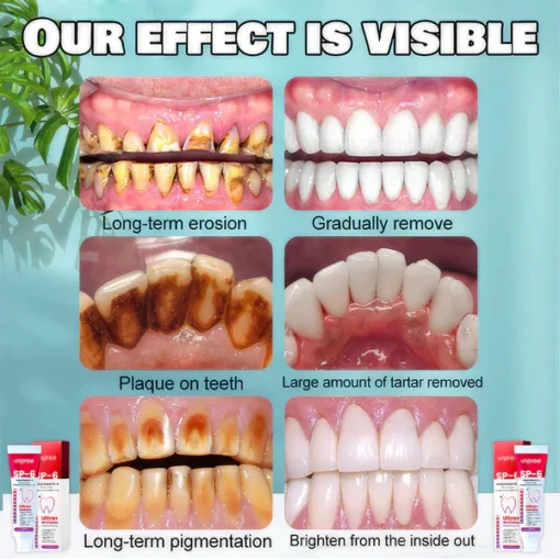 Unpree™ SP-6 Ultra+ Probiotic Whitening Toothpaste - Image 3