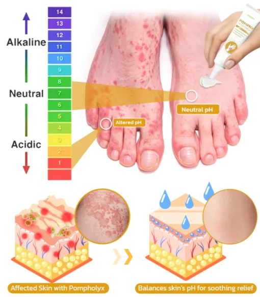 Fivfivgo™ Pompholyx Relief Cream - Image 5