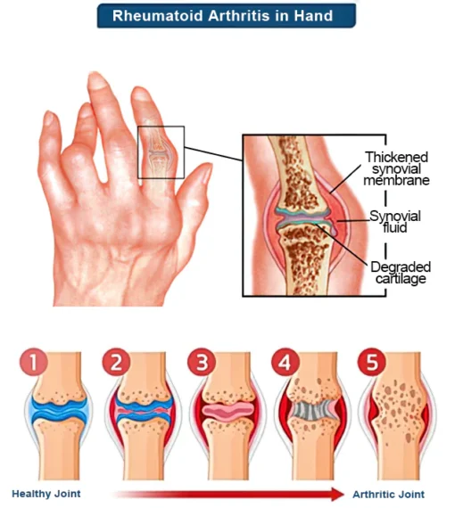 Posryst™ Bee Venom Joint and Gout Healing Gel - Image 3