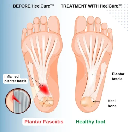 Seurico™ Plantar Fasciitis Herbal Cream - Image 3