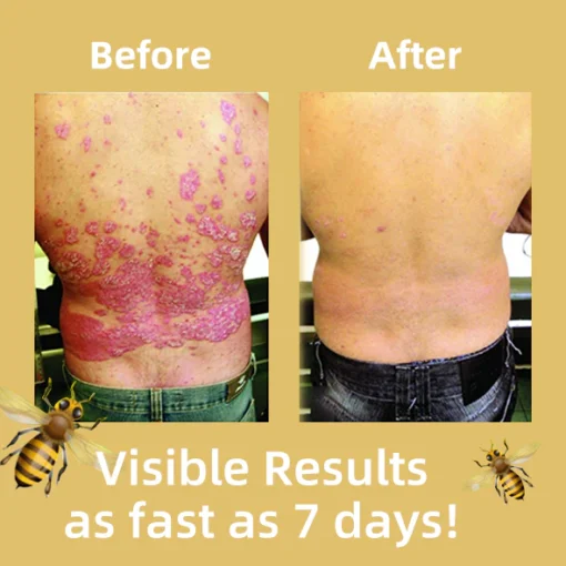 Fivfivgo™ New Zealand Bee Venom Psoriasis Treatment Cream - Image 3