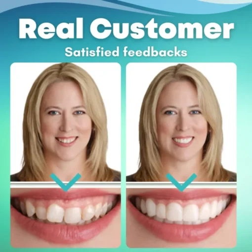 Before and after comparison with EzySmile™ veneers.