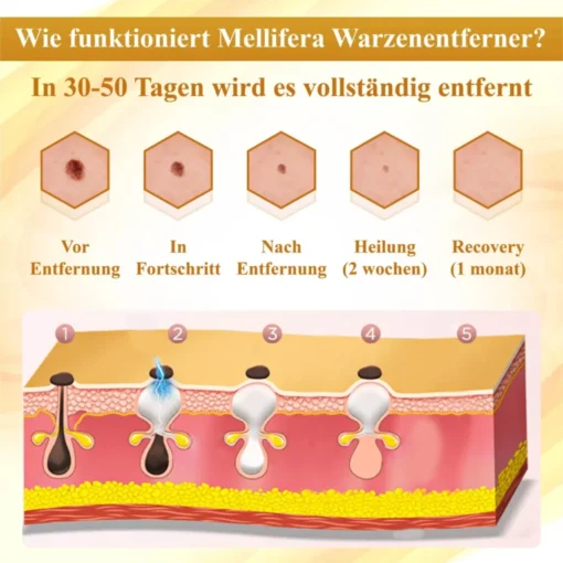 Hautheilung durch ATTDX™ Mellifera Apitherapie.