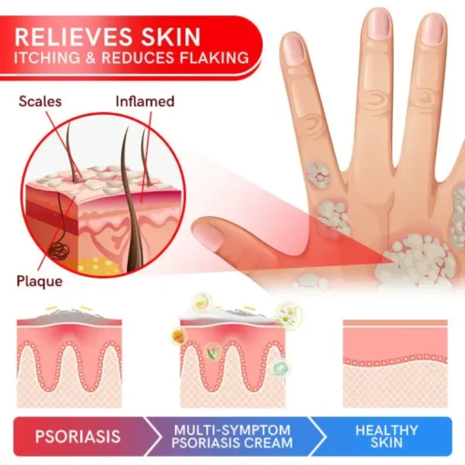 Texture of FLYCARE™ Bee Venom Anti-Flare Psoriasis Cream spread on a finger.