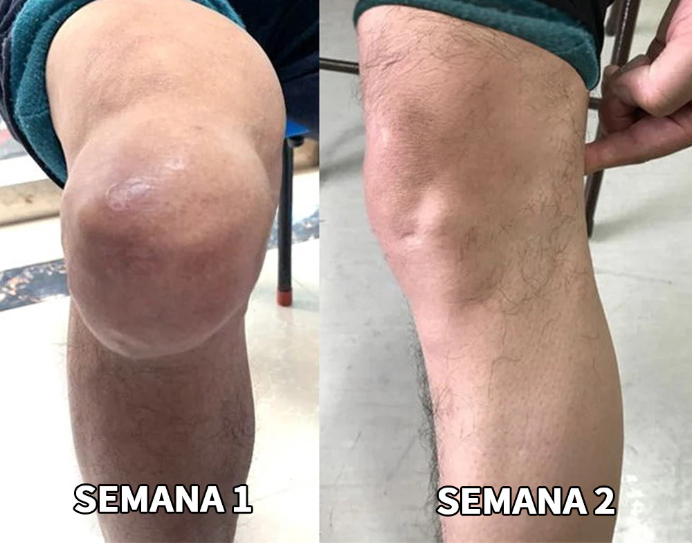 Ropceer™ Bee Venom Instant Ultra Pain Relief Healing Cream: Tratamento eficaz para artrite, proporcionando resultados visíveis em apenas 4 semanas de uso contínuo.