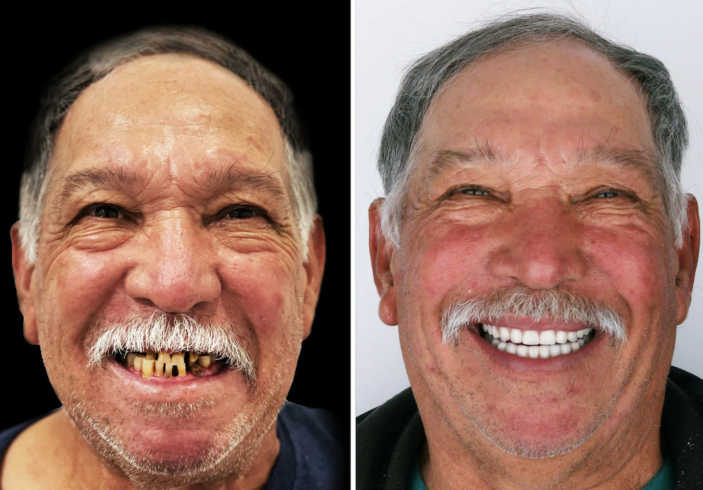 Enhance your smile for every occasion with SEAGRIL™ Silicone Reline Denture Set, designed for a flawless appearance.