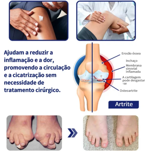 Ropceer™ Bee Venom Instant Ultra Pain Relief Healing Cream: Suporte poderoso para artrite e doenças articulares, promovendo a saúde das suas articulações.