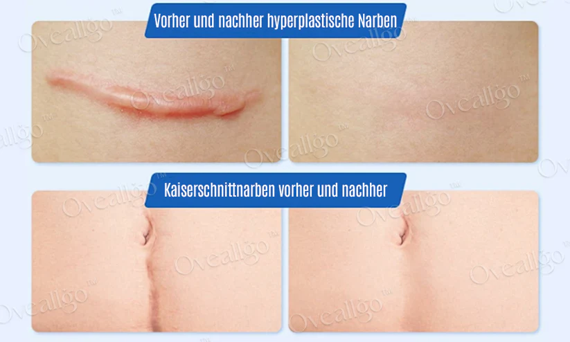 Oveallgo™ Silikon Anti-Narbencreme spendet die notwendige Feuchtigkeit für perfekte Haut.