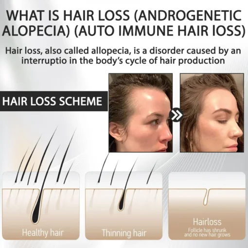 LOVILDS™ Alopecia Recovery Hair Booster Roll-On is a trusted choice for those facing hair thinning challenges.