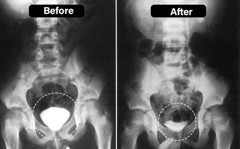 Nur ein Sprühstoß von Oveallgo™ BeeProsta Nasenspray für die Prostatagesundheit pro Tag hilft, Ihre Prostata zu unterstützen.