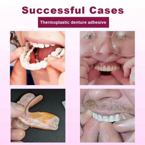 ATTDX™ SmileGrip Thermoplastic Denture Adhesive adapts to your gums, preventing dryness and irritation for enhanced comfort.