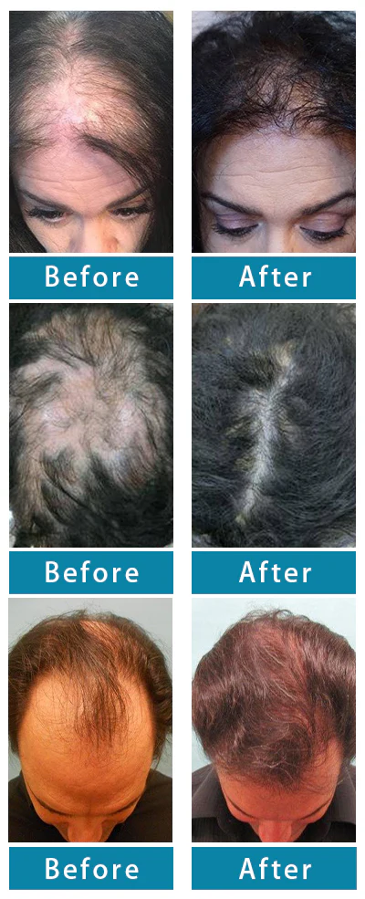 Experience effective hair regrowth with LOVILDS™ Alopecia Recovery Hair Booster Roll-On, praised by thousands of satisfied users.