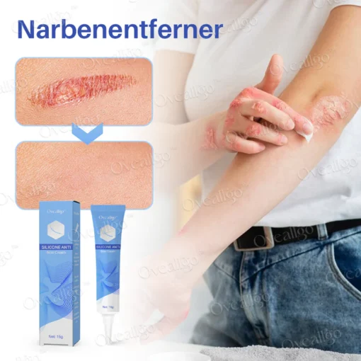 Oveallgo™ Silikon Anti-Narbencreme ist eine zuverlässige und effektive Lösung zur Narbenbehandlung.