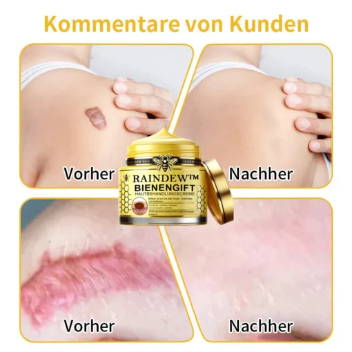 Nutzen Sie die kraftvollen Eigenschaften von Raindew™ Bienengift-Hautpflegecreme zur Entfernung von Hautflecken.