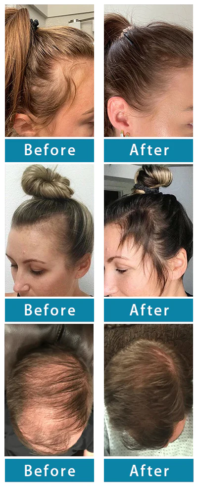 Say goodbye to hair loss with LOVILDS™ Alopecia Recovery Hair Booster Roll-On, delivering remarkable results.