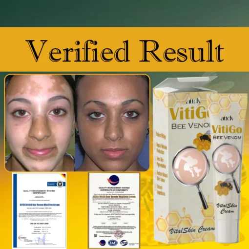 Revitalize your skin with ATTDX VitiGO Bee Venom VitalSkin Cream, which stimulates melanocyte function for enhanced pigmentation.