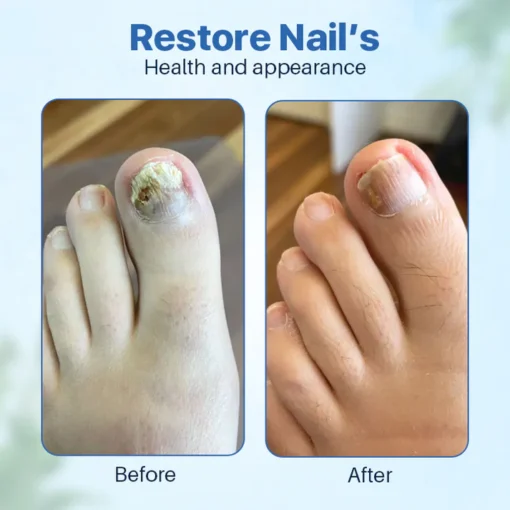 SEAGRIL™ Anti-Fungal Nail Repair Ointment targets nail infections quickly, providing a perfect solution for strong and shiny nails.