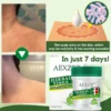 AEXZR™ Herbal Tinea Corporis Cream is enriched with Aloe Vera and Coconut Oil, soothing the skin effectively.