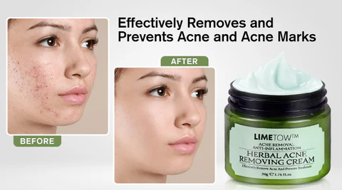 LIMETOW™ Herbal Acne Removal Cream is the perfect solution for oily skin, balancing sebum production and preventing future breakouts.