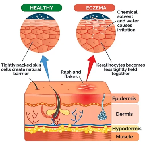 AEXZR™ Violet Eczema Treatment Cream is safe for all ages and is recommended by dermatologists for effective care.