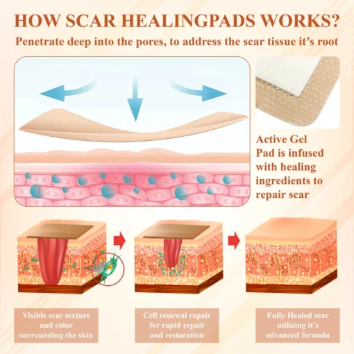 ScarEase™ SiliconeFoam Healing Pads are dermatologist-approved for effective scar management.